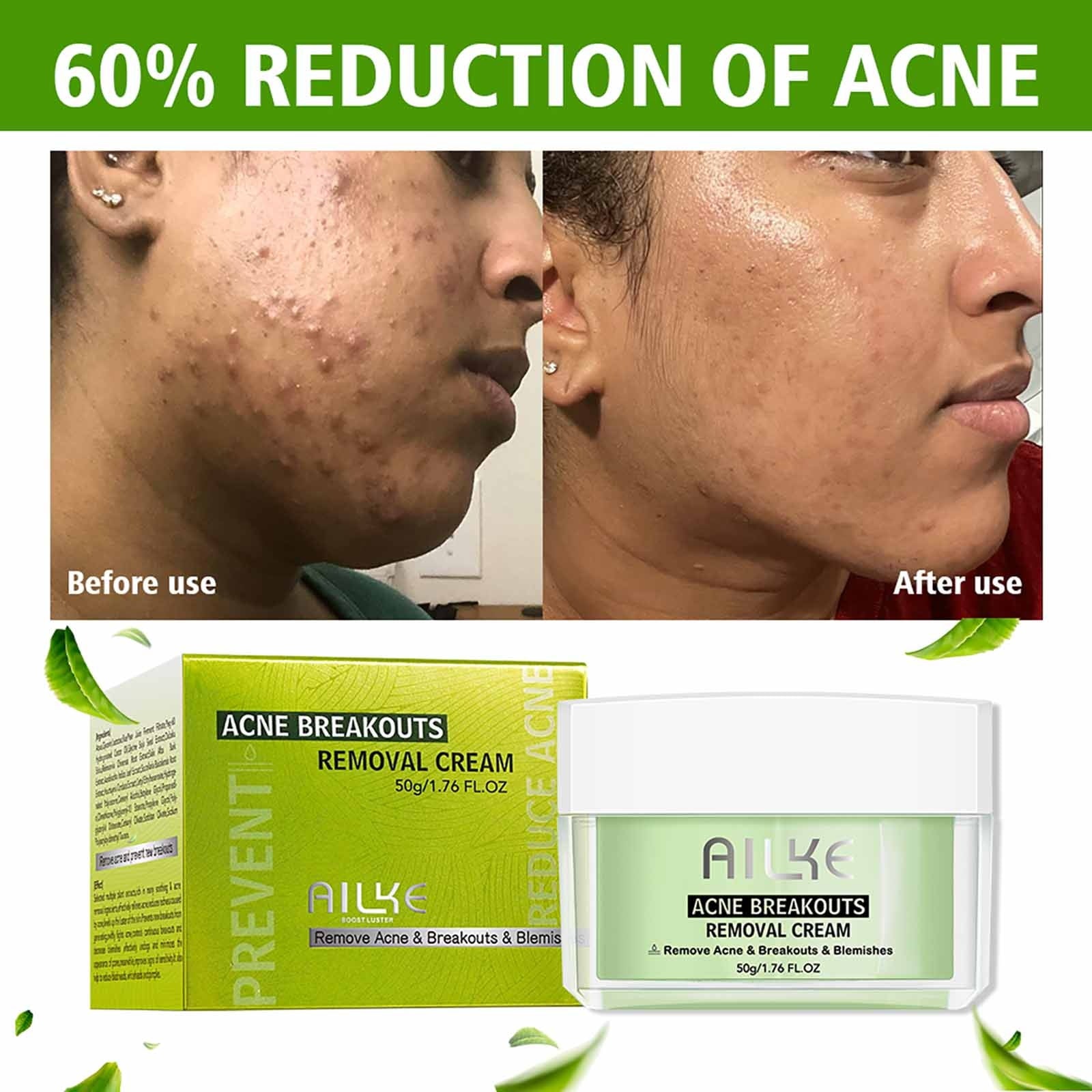 Natural Acne Breakouts Blemishes Removal Cream